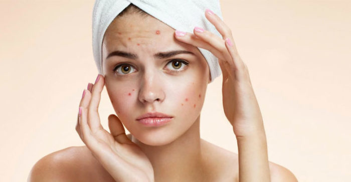 Best Home Remedies You Must Try To Get Rid of Pimples